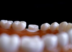 マウスピース矯正は通院不要でオンライン矯正が可能なのか？