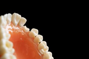 キレイライン矯正には追加費用があるのか確認する方法は？